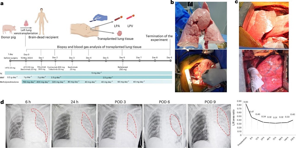 Что означает первая трансплантация легкого от генетически модифицированной свиньи человеку?