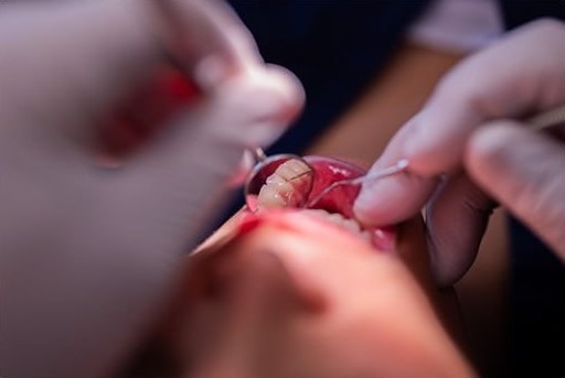 Как лечить кариес, чтобы избавиться от проблем со сном?