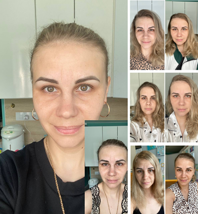 Как избавиться от утренней отечности лица: мой опыт борьбы с “китайским пчеловодом”