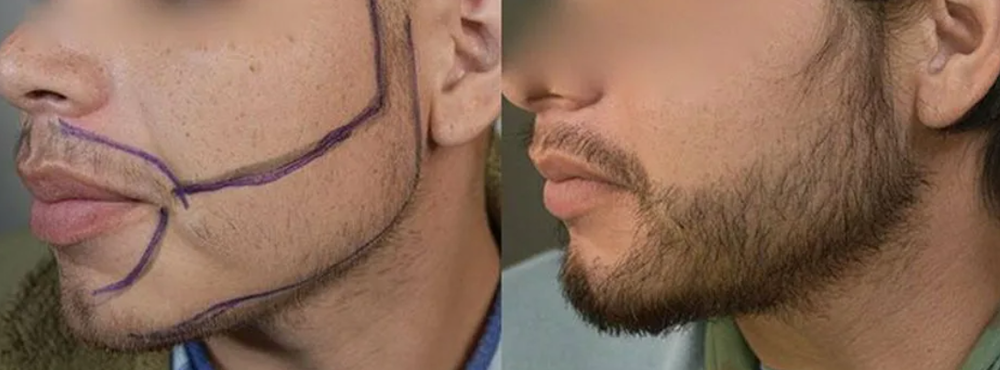 Мужская красота по-новому: бум наращивания волос и бород в России