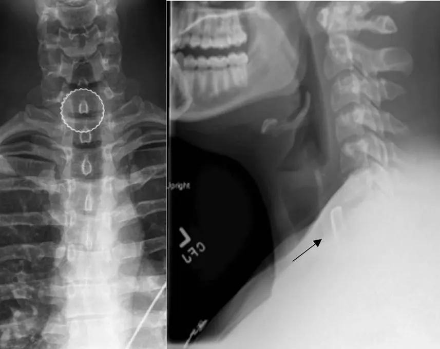 Невероятный случай на соревнованиях: крышка от пива чуть не убила студента