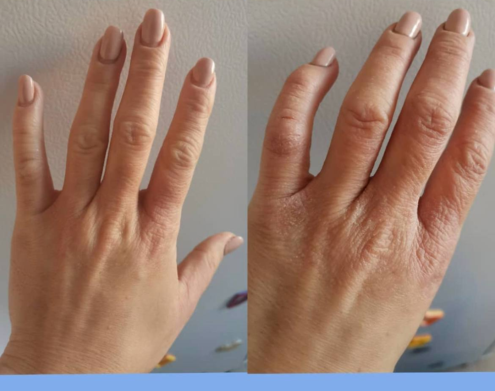 Как победить аллергию без антигистаминных