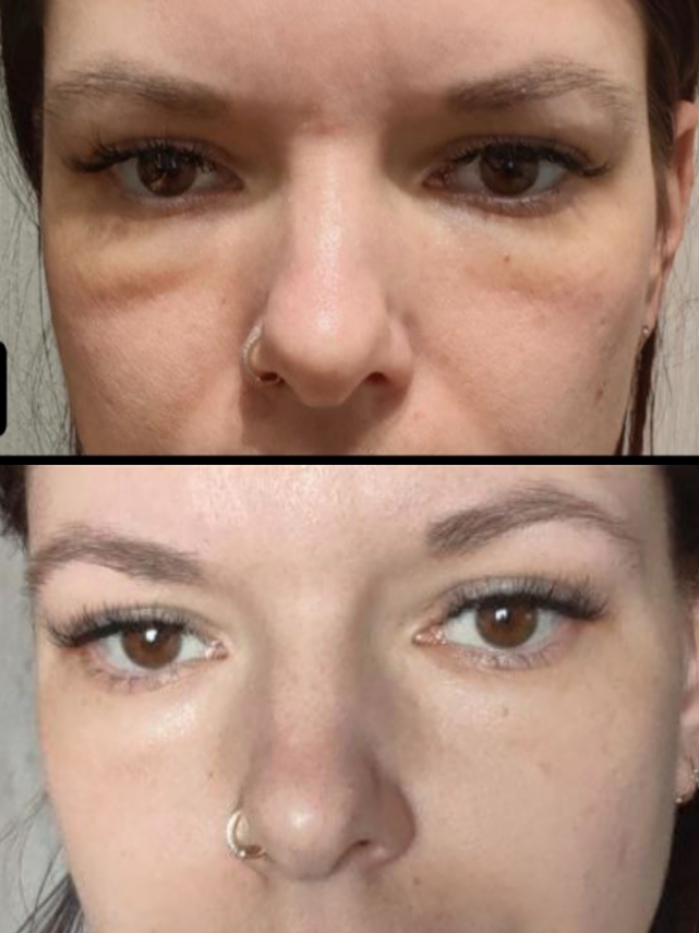 Как избавиться от отеков на лице: натуральный лимфодренаж для идеального утреннего отражения