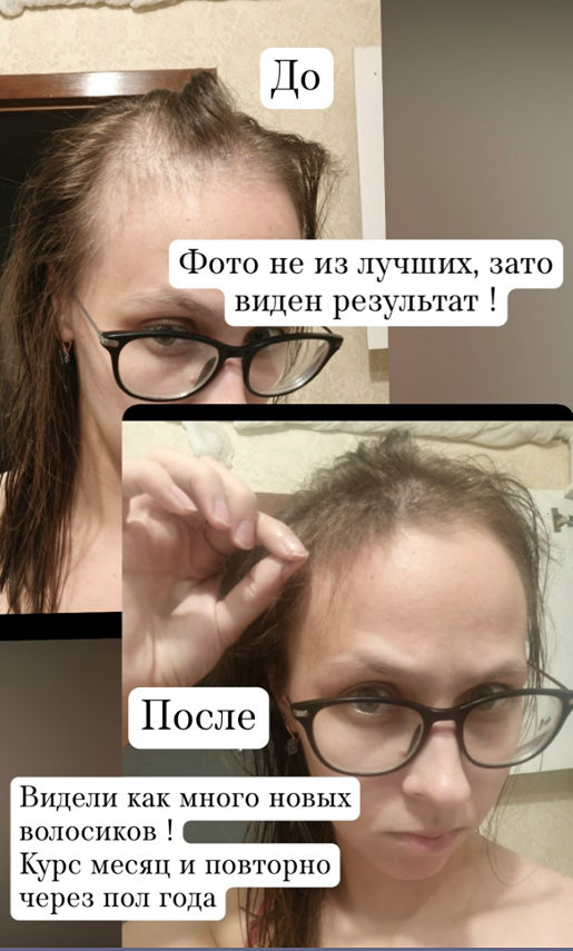 Как остановить выпадение волос и вернуть густоту: профессиональное решение для красивых локонов