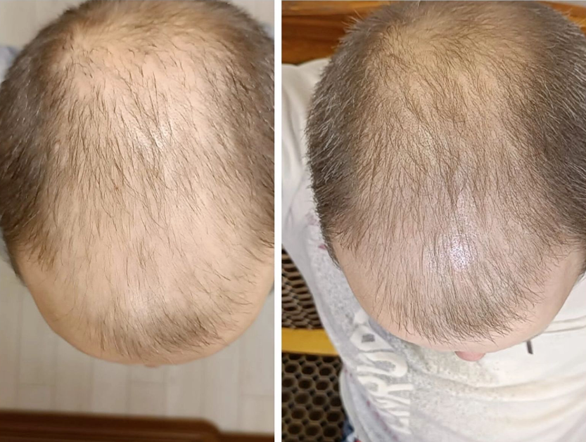 Как остановить выпадение волос у мужчин: немецкое решение для сохранения причёски