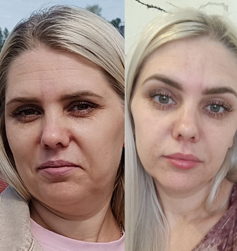 Биодоступный коллаген: как пептиды работают лучше обычного коллагена