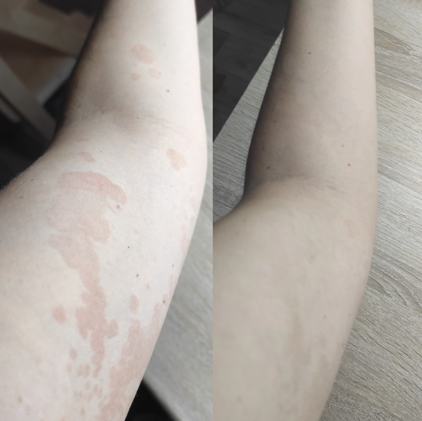 Печень — тихий герой организма: как LIVO GYAN помогает восстановить главный фильтр тела