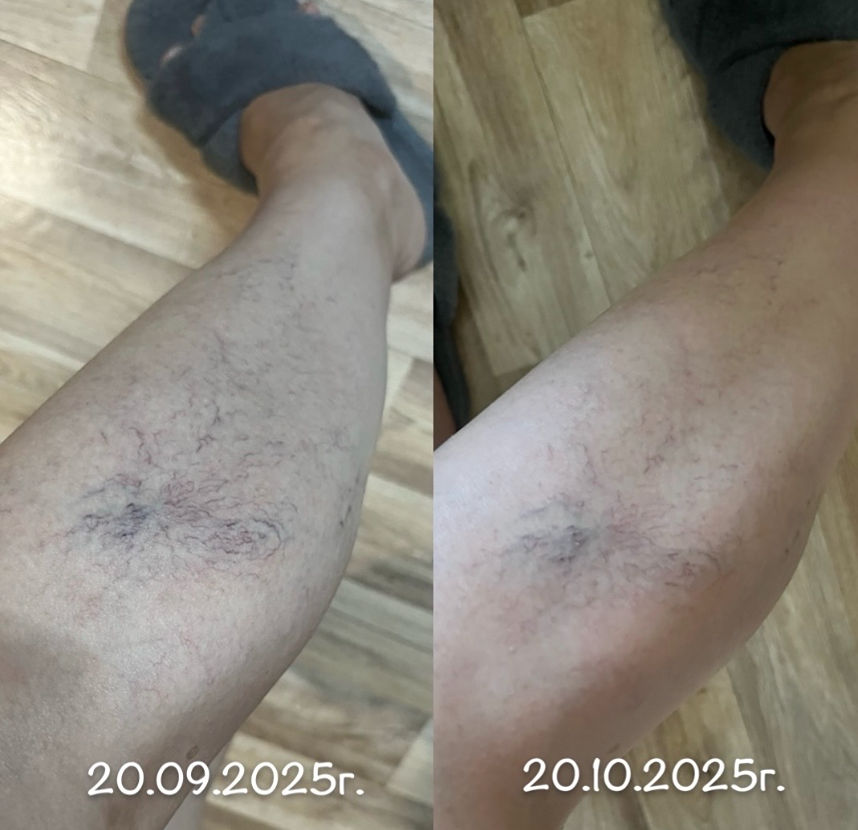 Как вернуть молодость сосудов: революционный подход