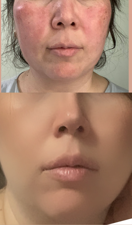 Когда кремы бессильны: BioDrone как спасение для проблемной кожи