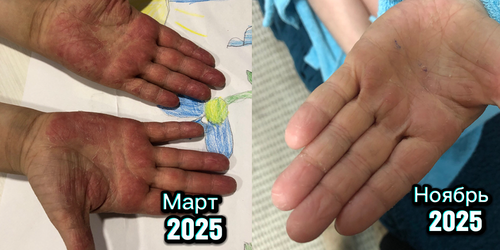 Как победить аллергию естественным путем