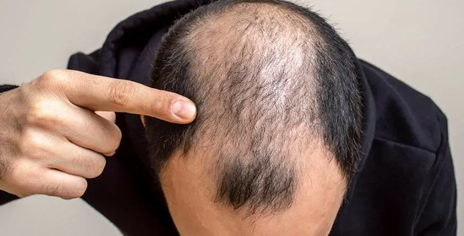 Жёсткая вода — путь к облысению: мнение специалистов