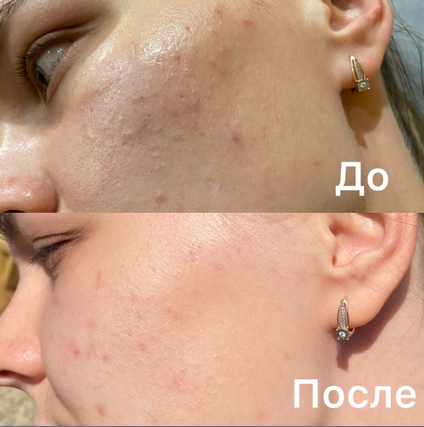 Как центелла азиатская и гиалуроновая кислота вернули моей коже сияние