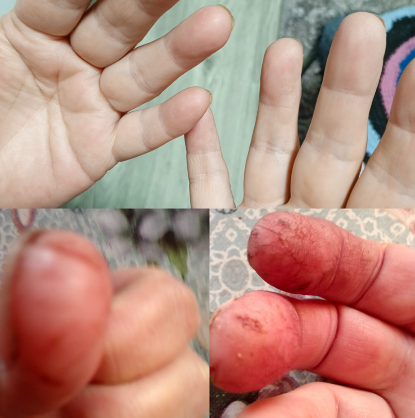 Аллергия на коже: от отчаяния к выздоровлению с натуральным комплексом