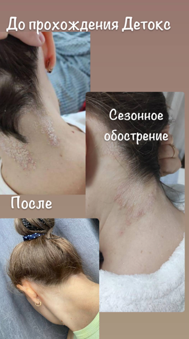 Как запустить естественное очищение организма и получить чистую кожу?