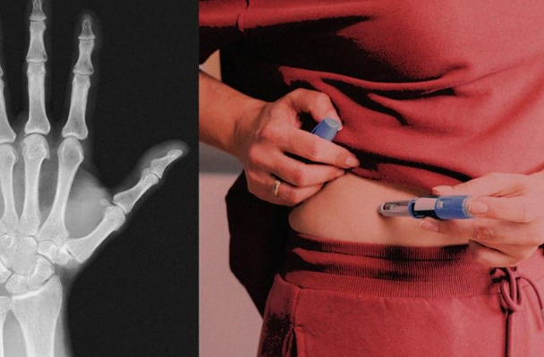 Оземпик и новые риски: исследование выявило опасность для костной системы