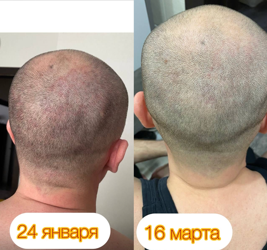 Здоровье начинается с кишечника? Как BioTuning помог при дерматите