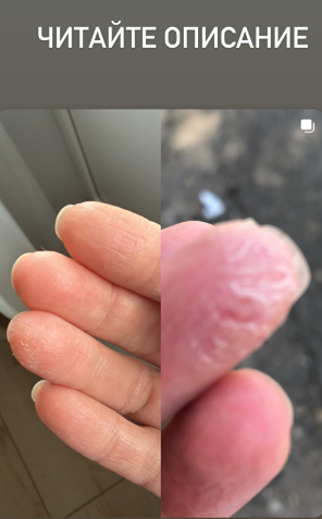 Вздутие и стресс: может ли Metabiotic восстановить микрофлору?