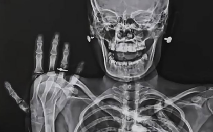 Рентген с кольцом — свадебный тренд среди российских медиков